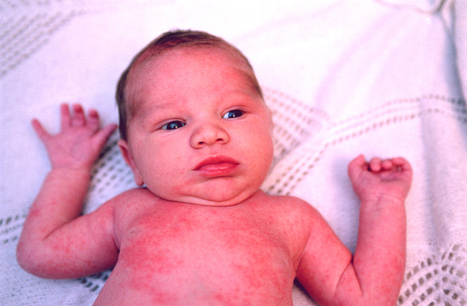 Heat Rash or Prickly Heat (Miliaria Rubra) in an Infant or ...