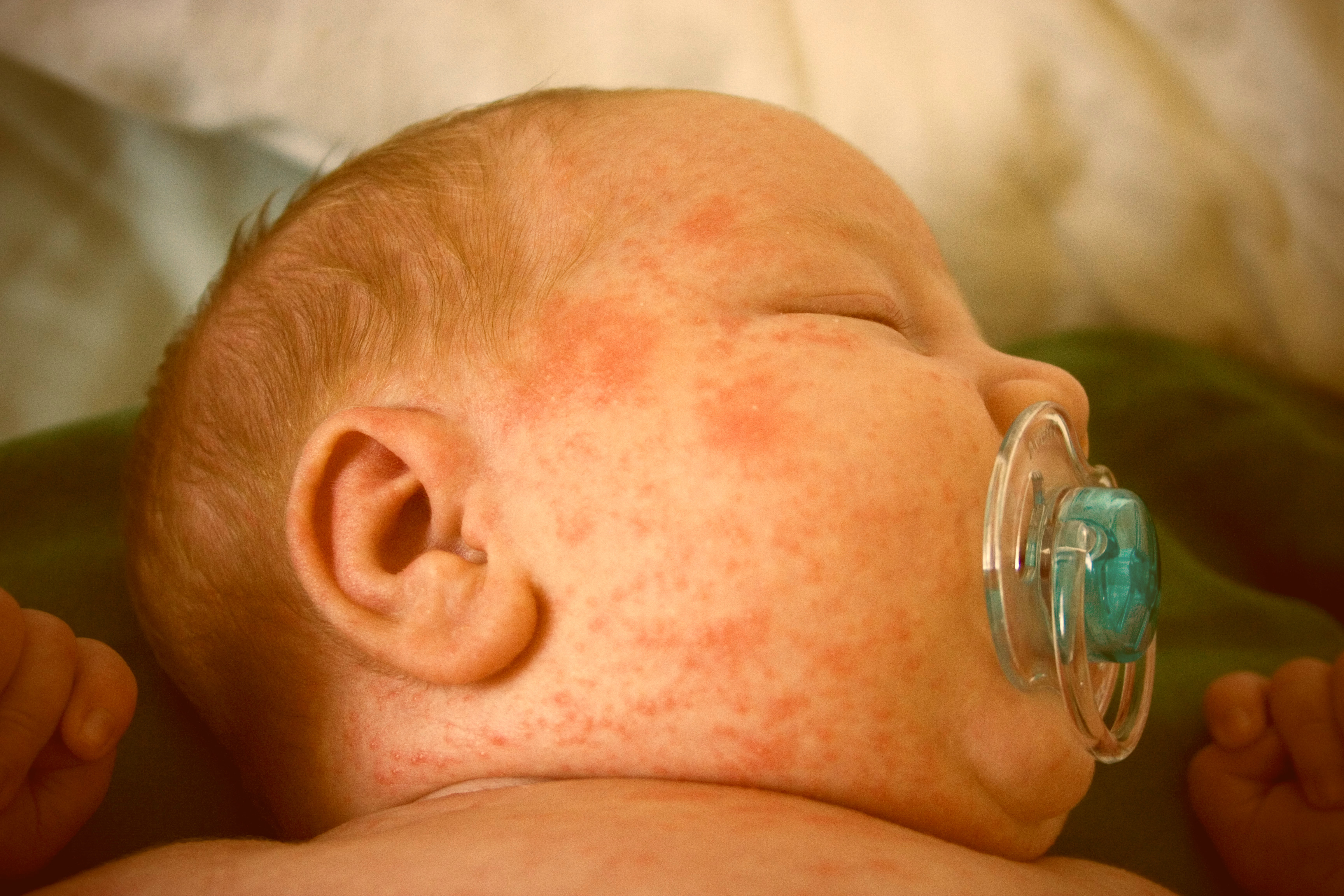 heat rash on infant #10