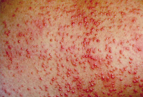 Heat Rash Pictures, Symptoms, Causes, & Treatments