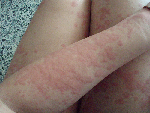 Free Heat Rash Pictures 50