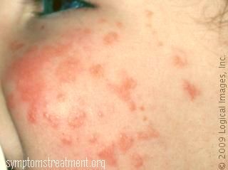 Roseola Symptoms - Mayo Clinic