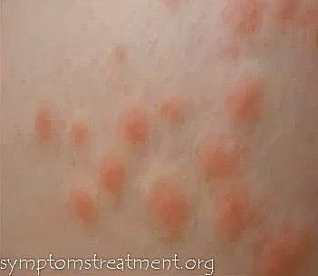 Bed Bug Bites