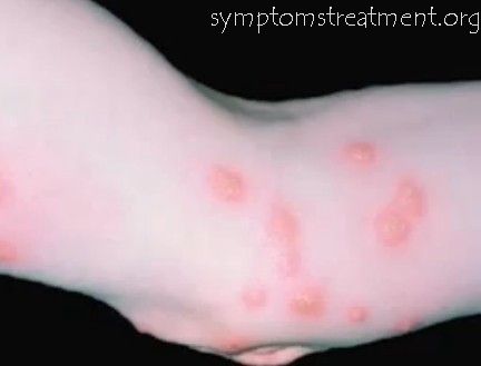 Bug Bite Symptoms, Bed Bug Bites Causes, and Bed Bug Bite Treatment ...