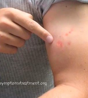 of bed bug bites that show the characteristic feature of these bites ...