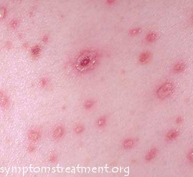 How long can a rash caused by chiggers last?