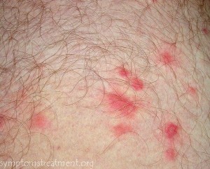 Chigger Bite Pictures, Treatment, Remedy, Photos
