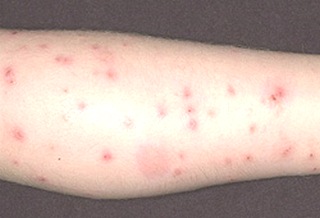 Flea Bites (Home Remedies and Treatments) Symptoms ...