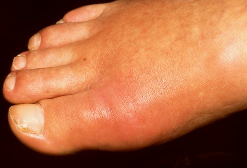 Gout Symptoms Foot - Here's a Checklist so You'll Know for ...
