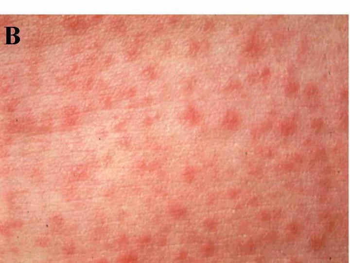 bacterial rash