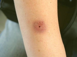 White tail spider bite pictures, symptoms, treatment, first-aid