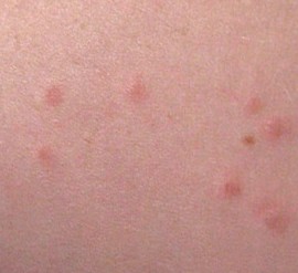 Flea Bites on Humans – Flea Bite Symptoms