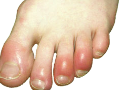 Athlete's Foot Symptoms, Treatment, Causes - What does ...