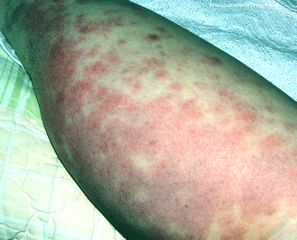 Roseola Symptoms, Treatment, Causes - MedicineNet