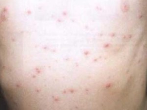 first signs of chickenpox