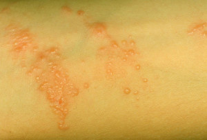 Contact dermatitis due to topical steroids