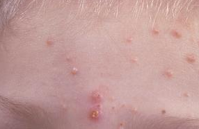 Molluscum contagiosum images