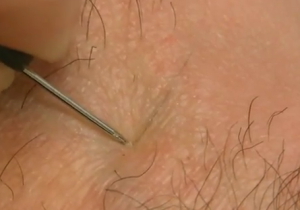 Ingrown hair - Pictures, Removal, Infection, Treatment