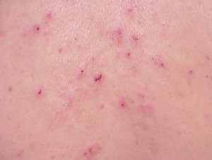 Small blood red spots on skin - Dermatology - MedHelp