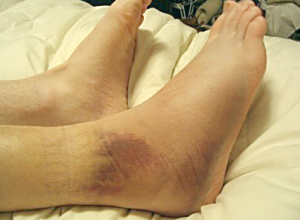 Broken ankle - Pictures, Recovery, Surgery, Treatment