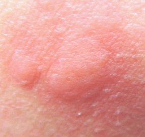 Mosquito bites - Pictures, Itch, Allergy, Swelling, Remedies