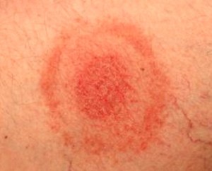 tick bite image