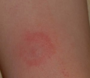 tick bite pictures arm