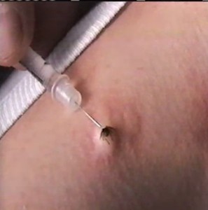 tick bite treatment removal