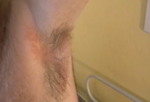 rash under armpit