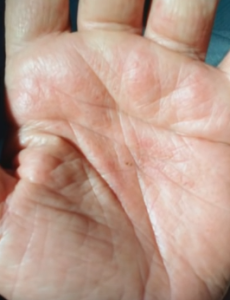 Amoxicillin rash hand