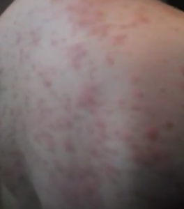 Amoxicillin rash pictures