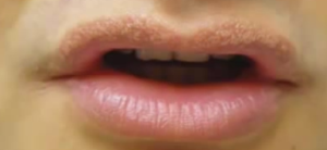 Fordyce spots on Lips