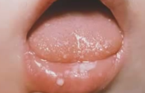 Fordyce spots on Lips images