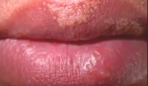 Fordyce spots on Lips pictures