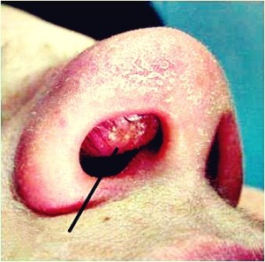 Nasal Vestibulitis photos