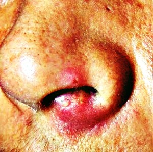 Nasal Vestibulitis pics