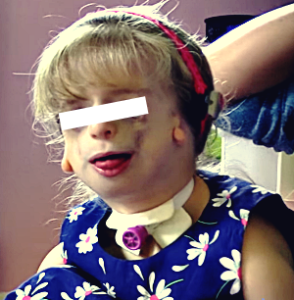 Treacher Collins Syndrome images