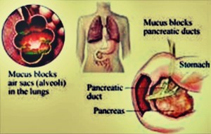 Turner Syndrome images