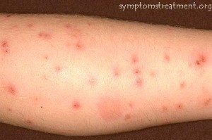 Bed Bug Bites :; How to treat a bed bug bite