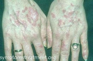 Lupus Rash Pictures, photos, Lupus Buttery Fly Rash,