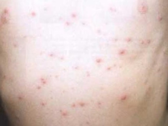 Mild chicken pox pictures, Symptoms, Treatment, Causes