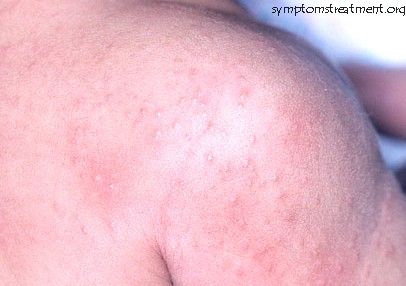 Prickly Heat Rash Pictures, Treatment, Symptoms