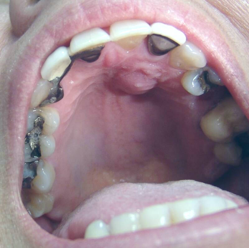 Dental Abscess Antibiotics Pictures Symptoms Treatment