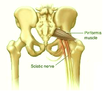 Piriformis Syndrome - Symptoms, Treatment, Causes