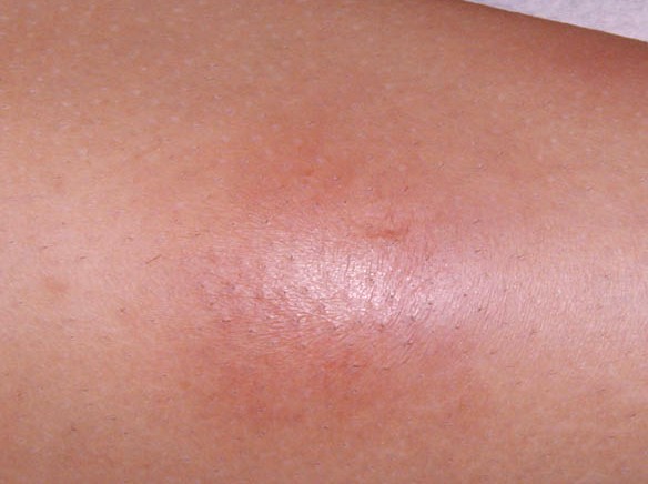 erythema-nodosum-pictures-treatment-causes-symptoms