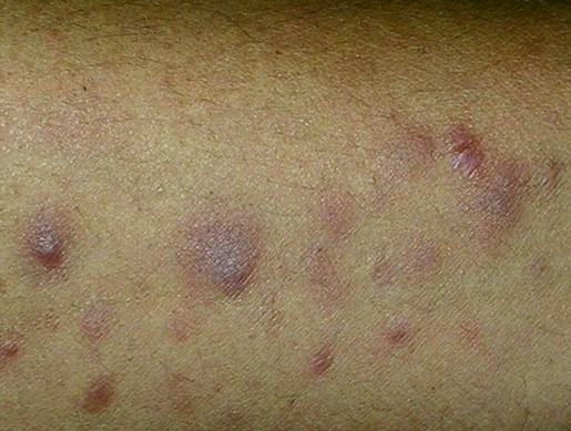 Erythema Nodosum - Pictures, Treatment, Causes, Symptoms