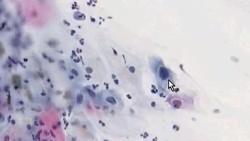 Low Grade Squamous Intraepithelial Lesion