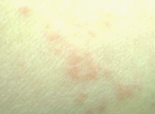 Mosquito bites - Pictures, Itch, Allergy, Swelling, Remedies