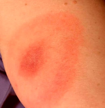 Tick Bite – Pictures, Symptoms, Causes, Treatment