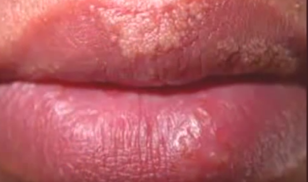 Fordyce spots on Lips