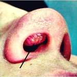Nasal Vestibulitis